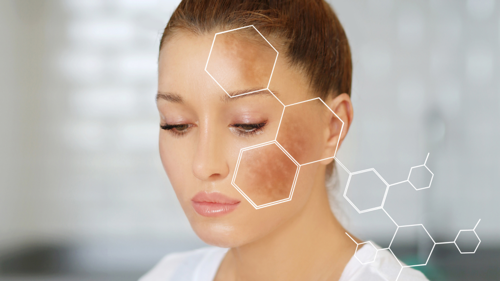 3 coisas que você precisa saber sobre o melasma.